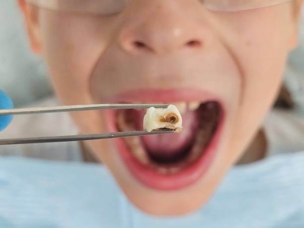 Best Tooth Infection Emergency Dentist  in Layhill, MD